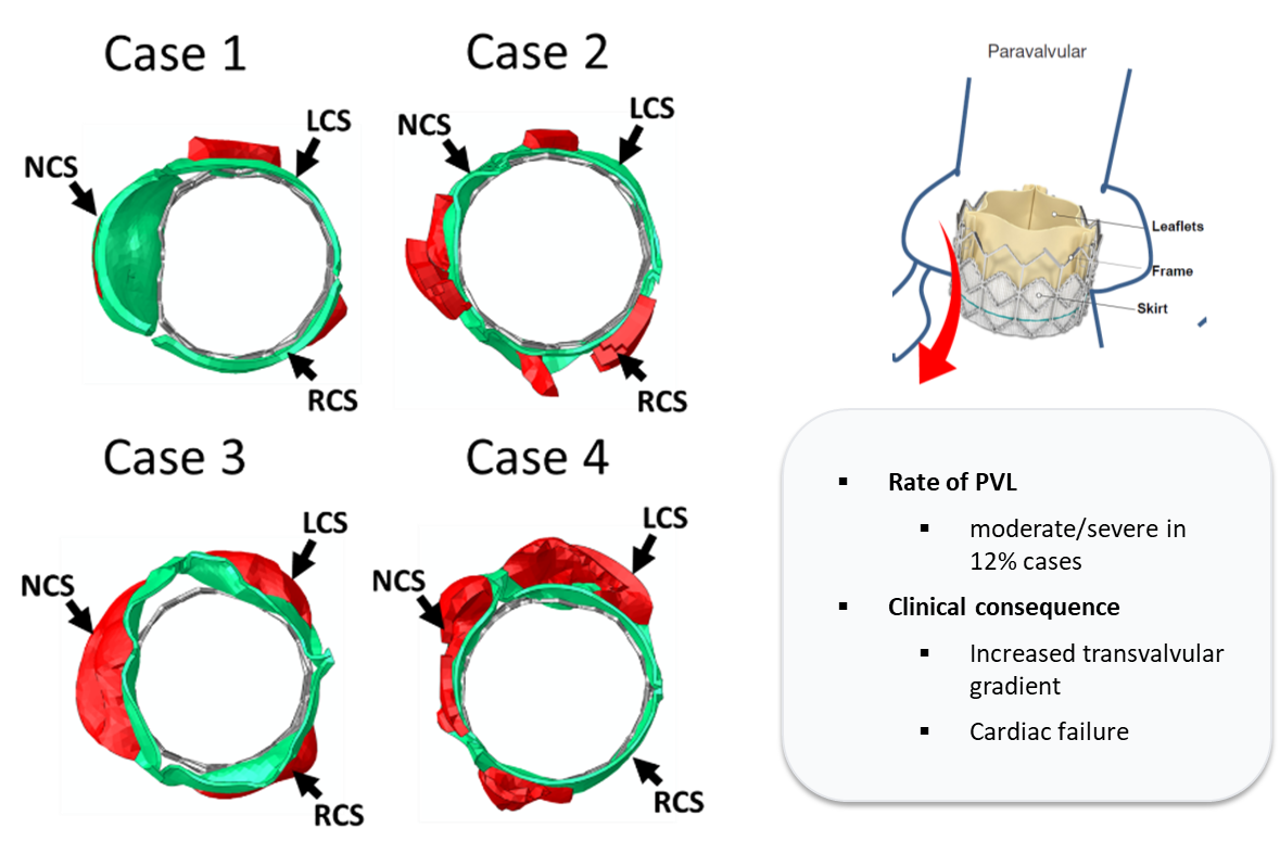 Paravalvular leakage analysis