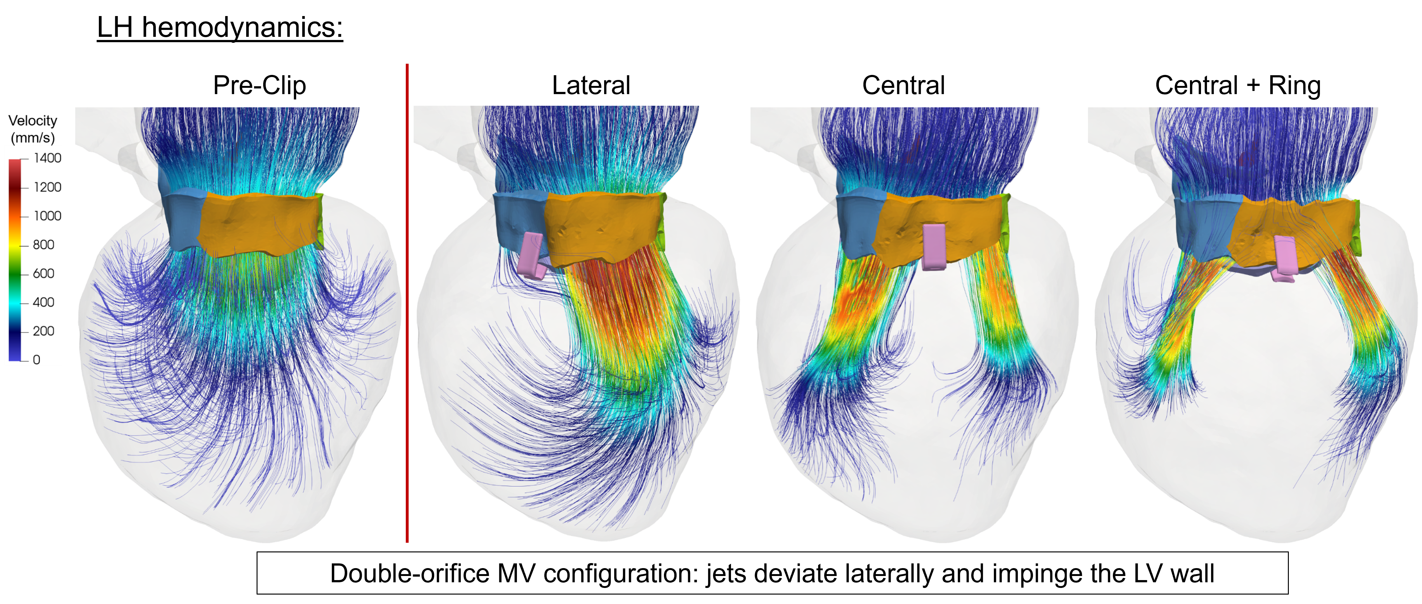 TEER stress distribution